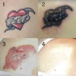 Does tattoo removal really work?