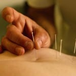 Does Acupuncture really work?