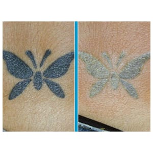 Does Tattoo Removal Cream work?