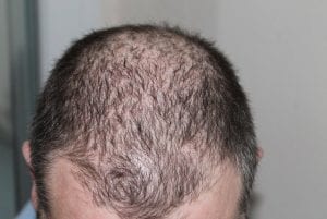 hair loss