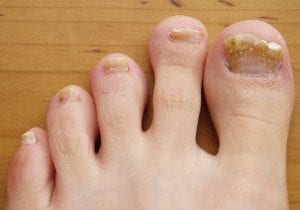 Nail fungus