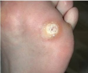 Plantar Warts