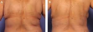 Does CoolSculpting Work?