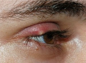 Eyelash problems